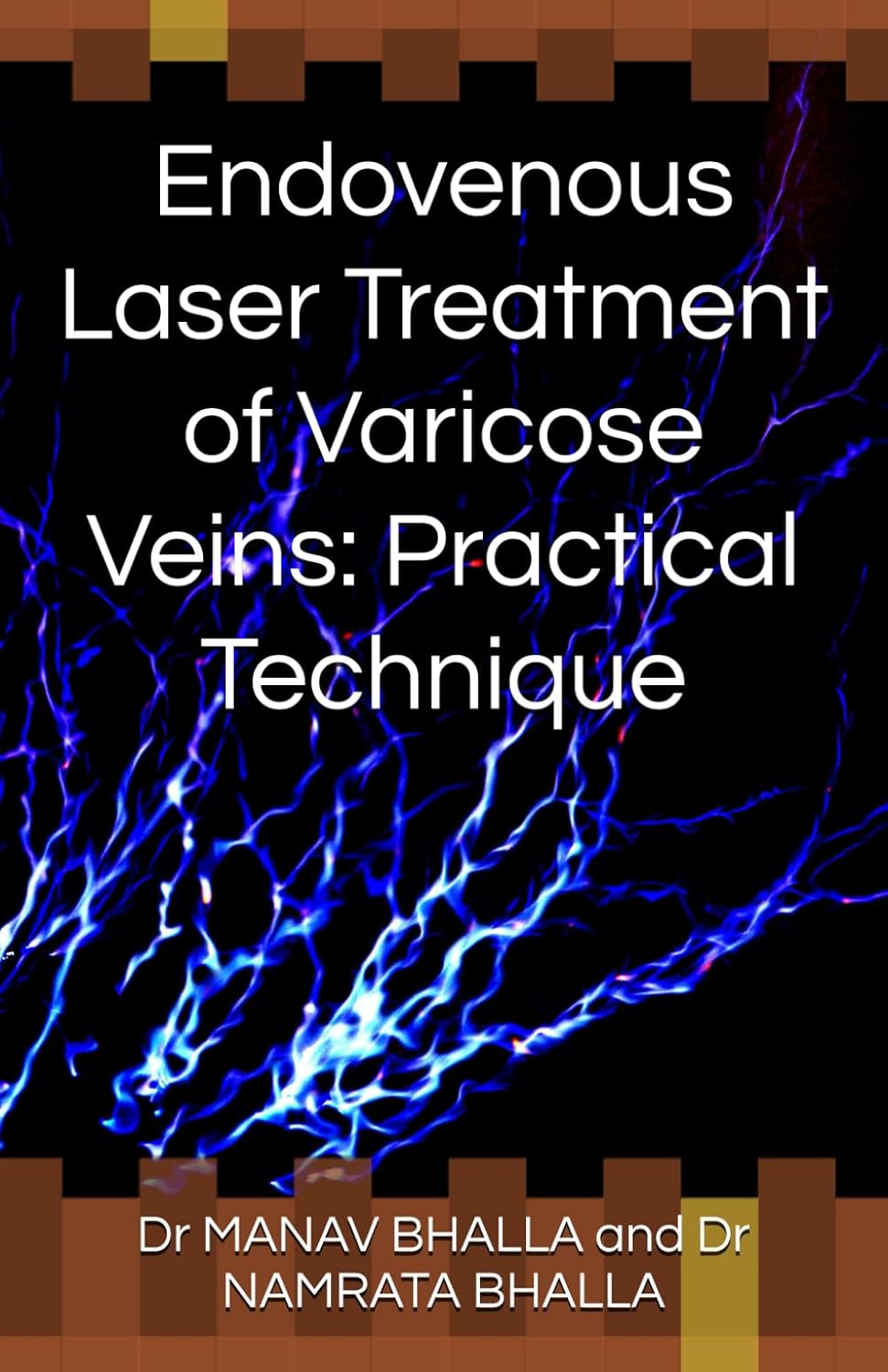 Endovenous Laser Treatment of Varicose Veins: Practical Technique