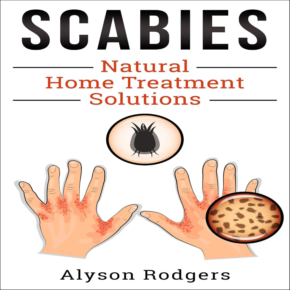 Scabies Natural Home Treatment Solution